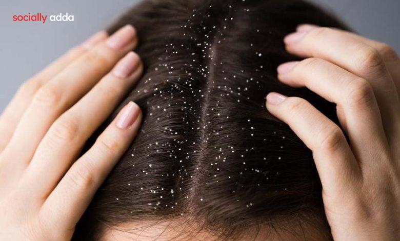 Home Remedies for Dandruff: डैंड्रफ हटाने के घरेलू तरीके, हो जाएगी छुट्टी आज ही अपनाये - Hindi breaking news